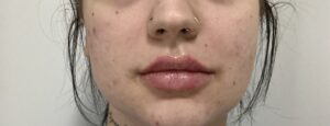 A client showcasing a fresh and natural-looking result following a professional lip enhancement procedure.